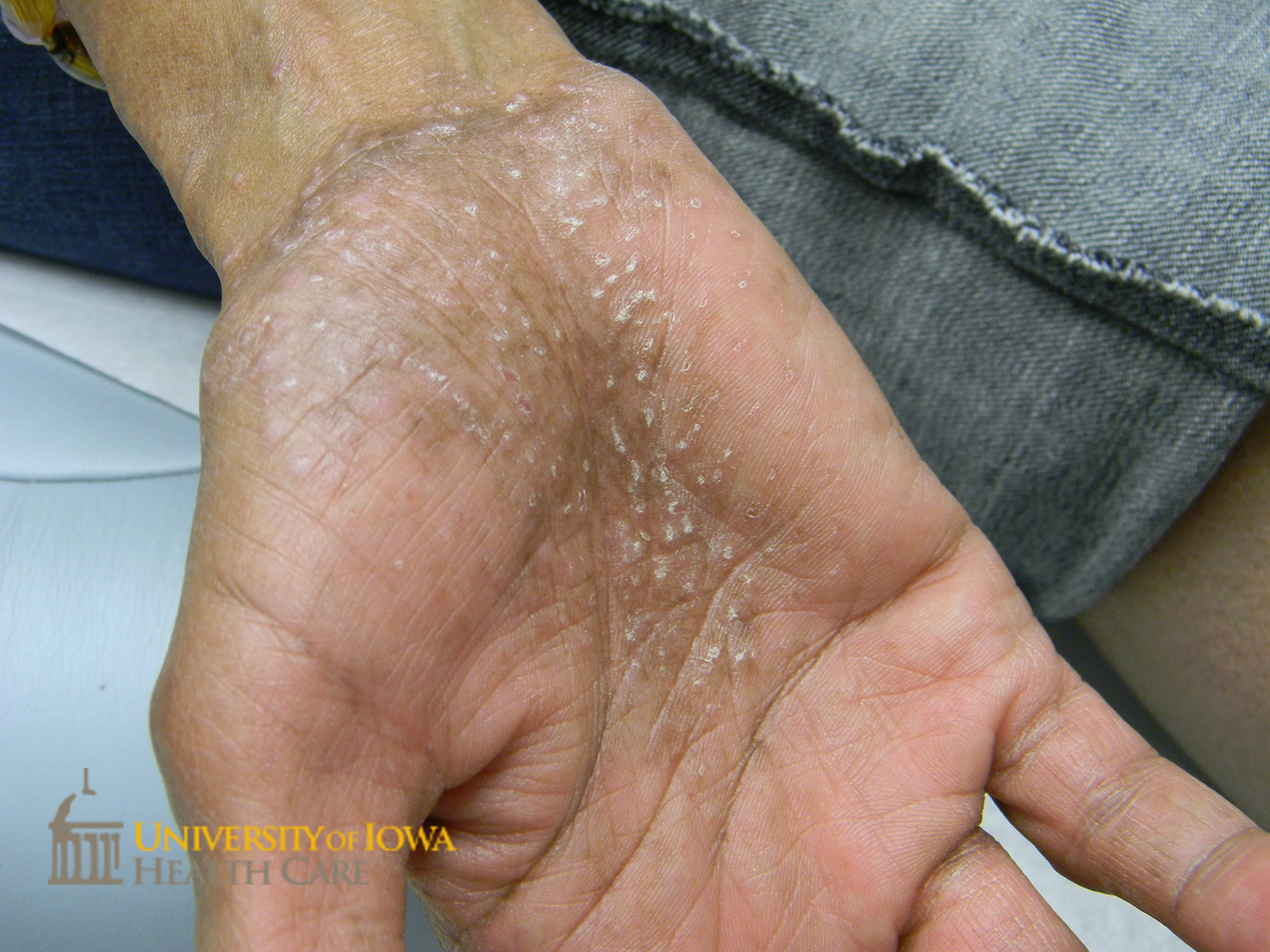 Numrous 2-3 mm brwoin papules with central white scale on the palms. (click images for higher resolution).